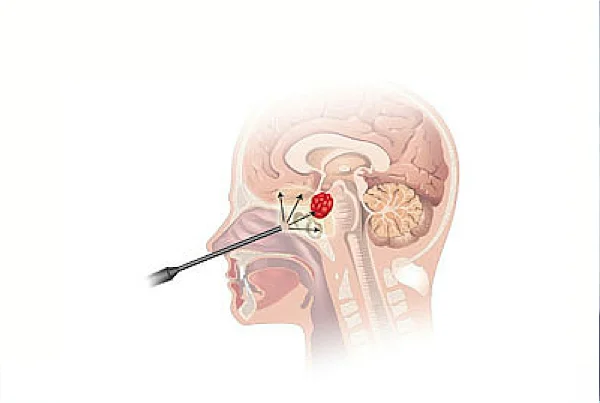 Cranial Endoscopy