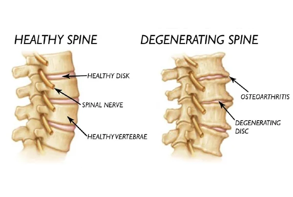 Degenerative Spine
