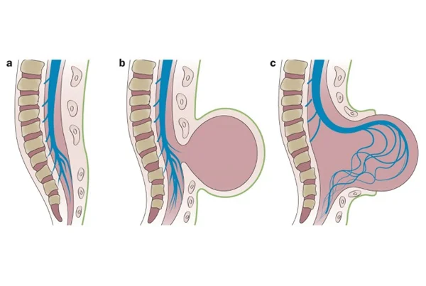 Spinal Dysraphism